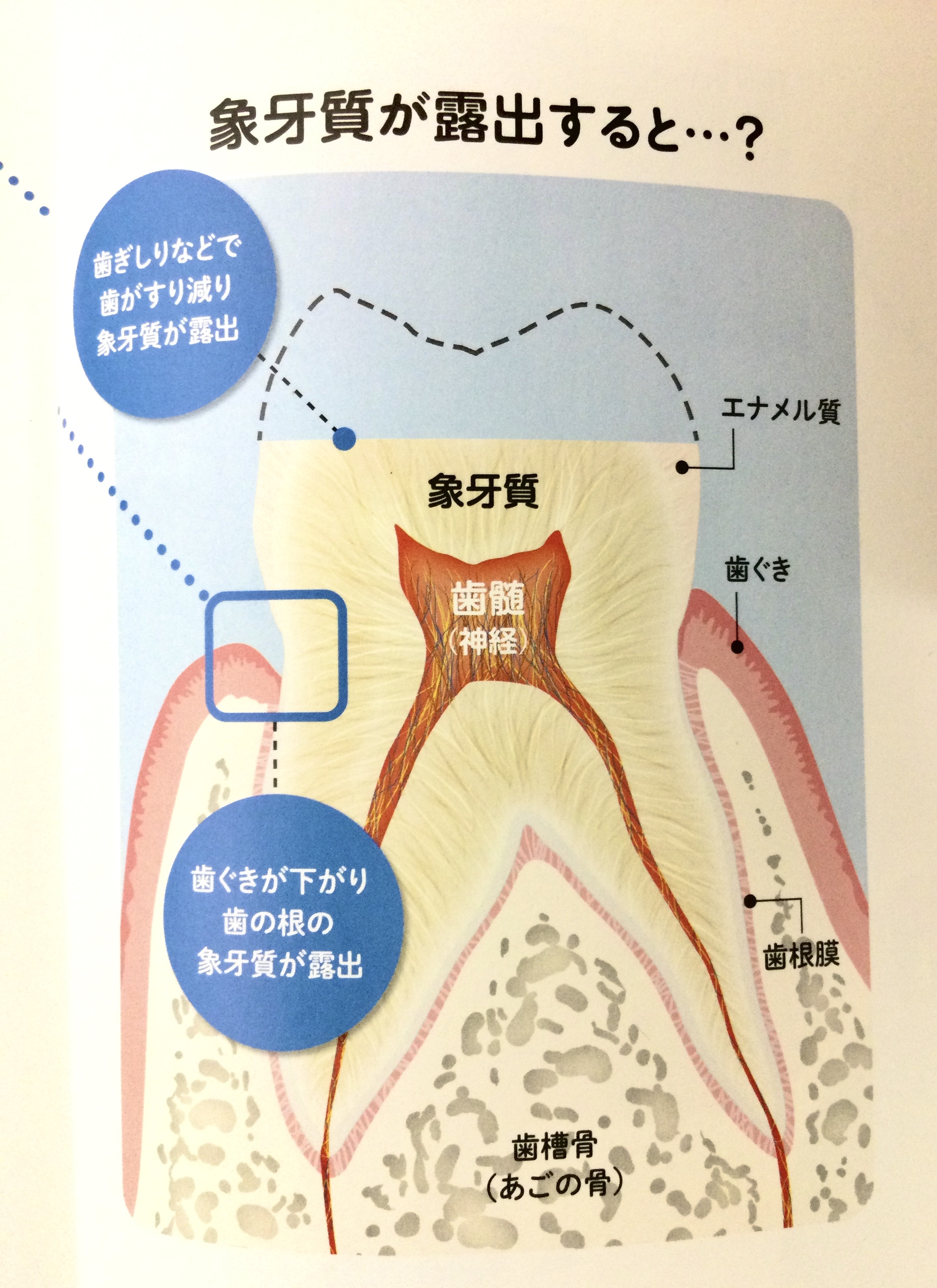 急 に 知覚 過敏